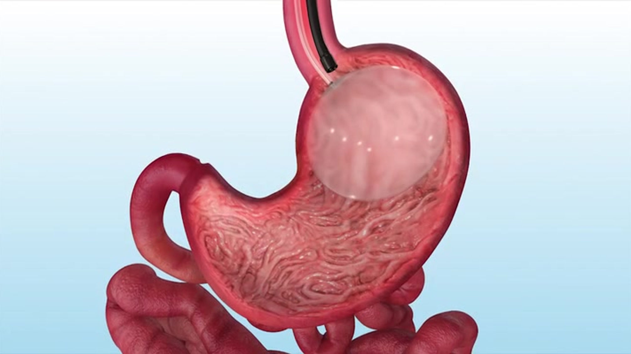 ORBERA Patient Animation - Placement